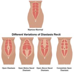 diastasis 4 kinds
